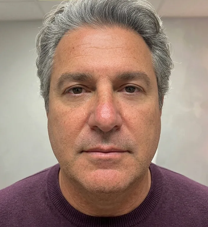 Augenpartie glatt nachher